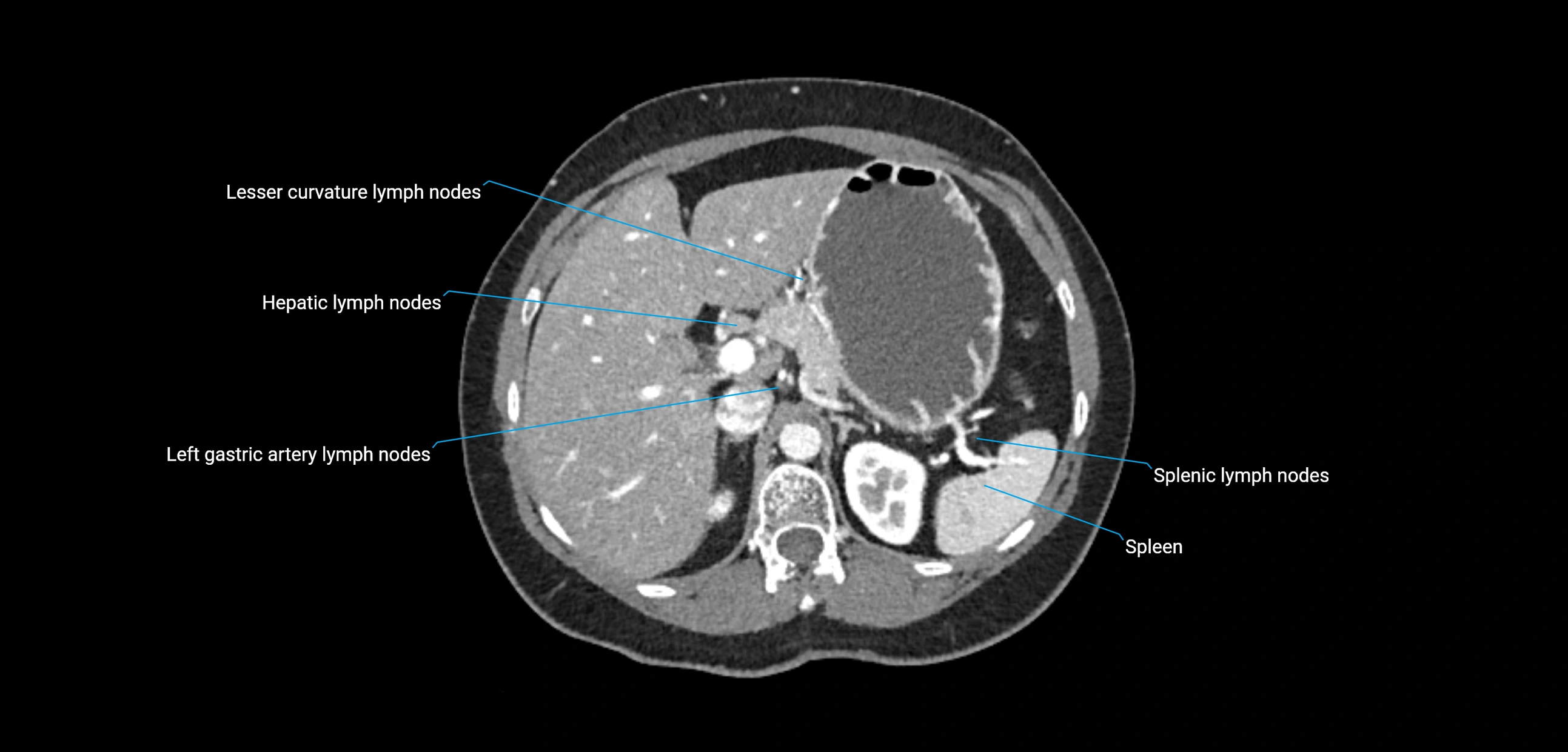 CT ct abdominal lymph nodes  axial cross sectional anatomy  enchanced radiology image -img-00002-00135.webp